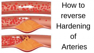 How to reverse Hardening of Arteries?