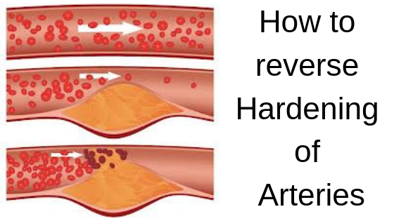 how-to-lower-blood-pressure-instantly-naturally-no-drugs-no-side-effect