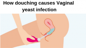 How douching causes Vaginal yeast infection