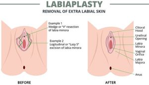 Understanding the Labia