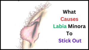 What Causes Labia Minora To Stick Out