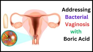 Addressing Bacterial Vaginosis with Boric Acid