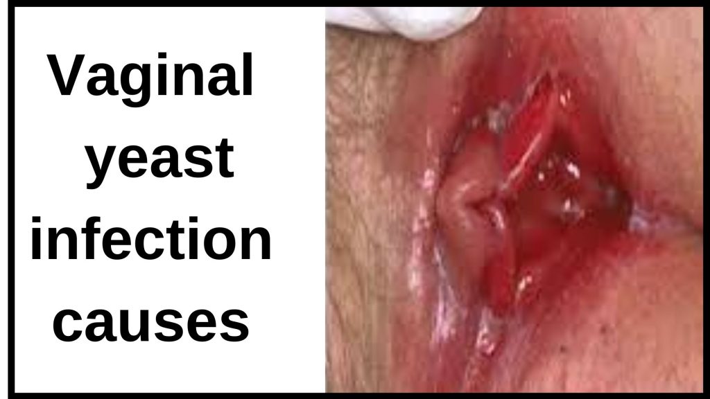Vaginal yeast infection causes