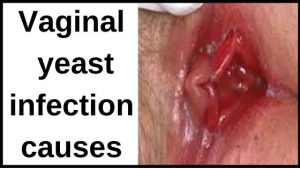 Vaginal yeast infection causes