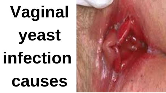 Vaginal Infection Spotting