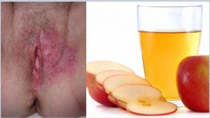 Apple Cider Vinegar Bath for Yeast Infection