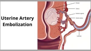 Uterine artery embolization