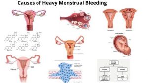 causes of heavy menstrual bleeding