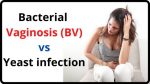 BV vs Yeast infection: Ultimate Guide on BV & Yeast infection