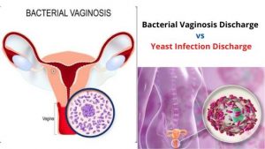 Bacterial Vaginosis Discharge vs Yeast Infection Discharge
