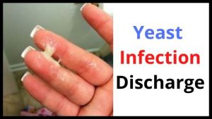Yeast Infection Discharge