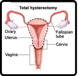 Total Abdominal Hysterectomy