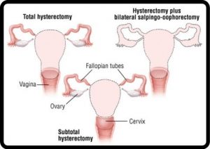 Total Hysterectomy with bilateral salpingo-oophorectomy