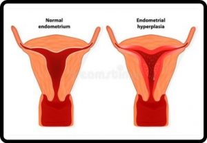 endometriosis