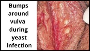 Bumps around vulva during yeast infection