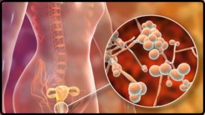 Causes of Fungal Infection during Menstruation Cycle