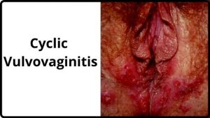 Cyclic Vulvovaginitis