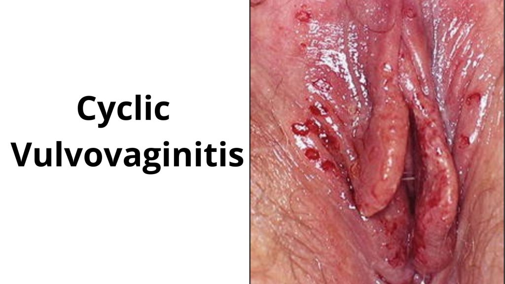 Cyclic Vulvovaginitis