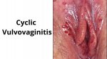 Cyclic Vulvovaginitis: The Surprising results from Doing this instead