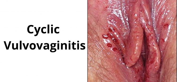 Cyclic Vulvovaginitis