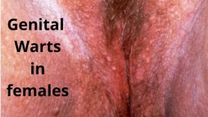 Genital Warts in females