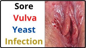 Sore Vulva Yeast Infection