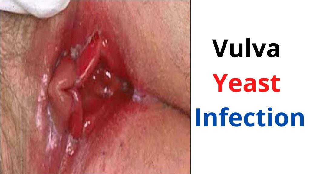 Vulva yeast infection