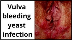 Vulva bleeding yeast infection
