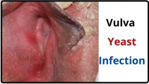 Vulva yeast infection