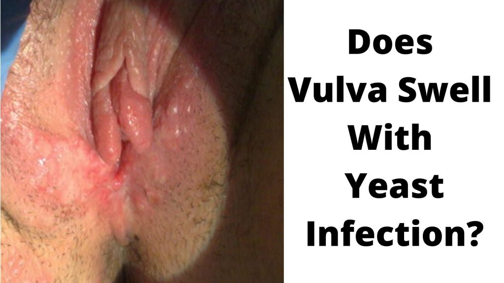 Does Vulva Swell With Yeast Infection