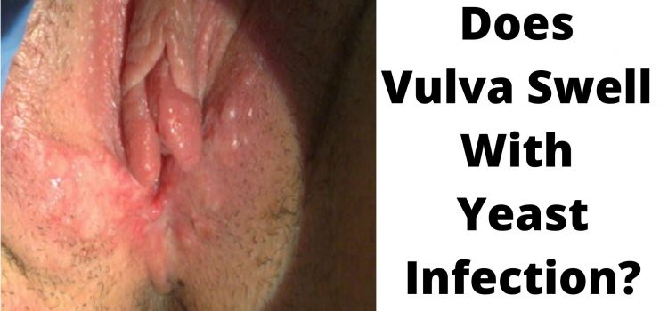 Does Vulva Swell With Yeast Infection