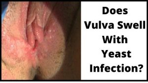 Does Vulva Swell With Yeast Infection