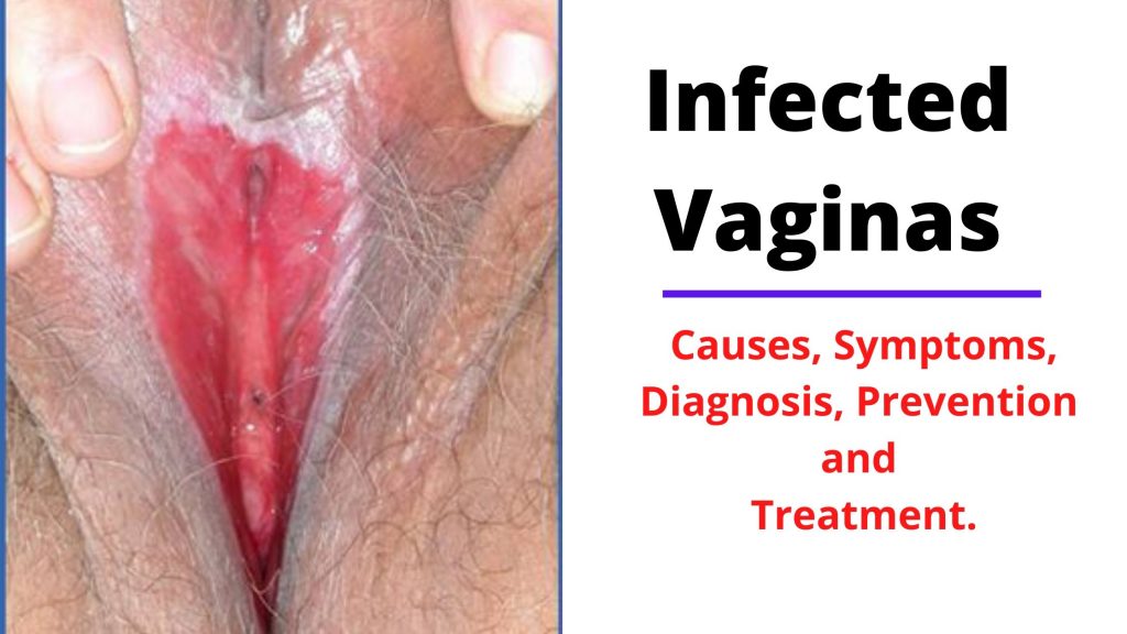 Infected Vaginas