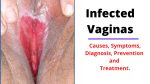 Infected Vaginas: Causes, Symptoms, Diagnosis, and Treatment.