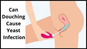 Can douching cause yeast infection