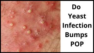 Do Yeast Infection Bumps POP