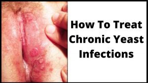 How To Treat Chronic Yeast Infections