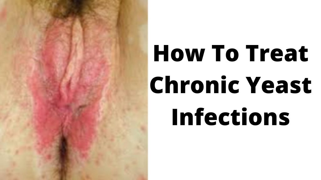 How To Treat Chronic Yeast Infections