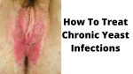 How To Treat Chronic Yeast Infections: Best & Effective Ways