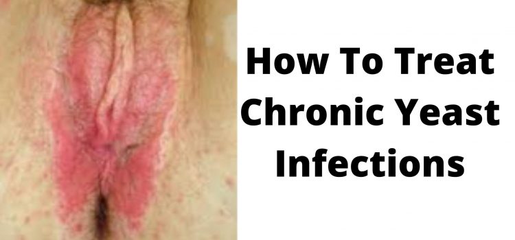 How To Treat Chronic Yeast Infections