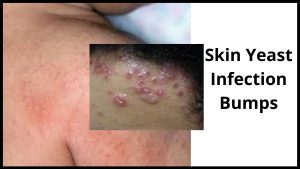 Skin Yeast Infection Bumps