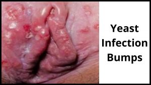 yeast infection bumps