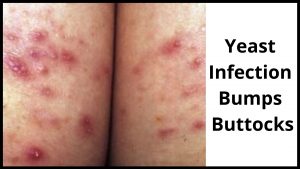 Yeast Infection Bumps Buttocks