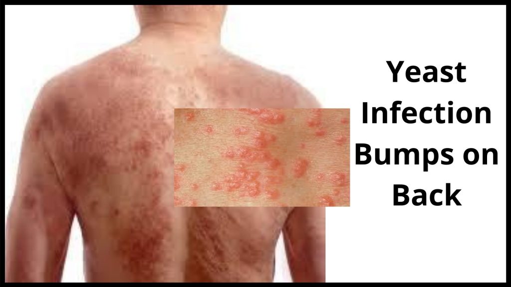 yeast-infection-bumps-causes-symptoms-treatment-cure