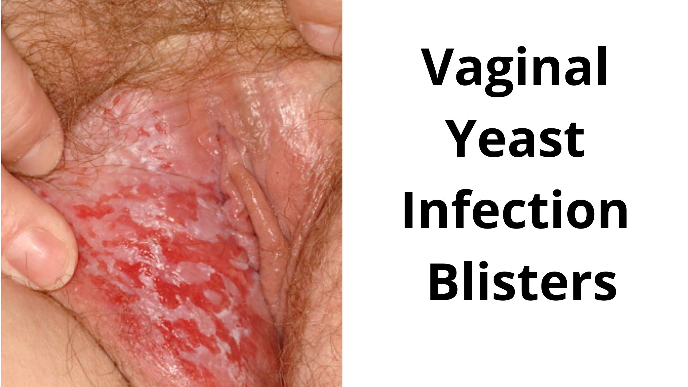 Vaginal yeast infection porn