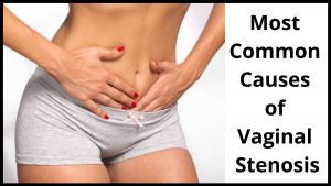 Most Common Causes of Vaginal Stenosis