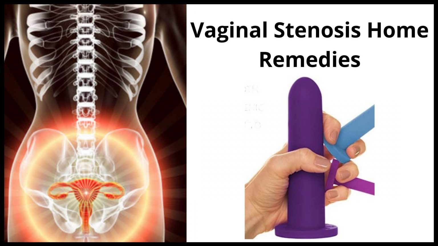Vaginal Stenosis Home Remedies Causes Symptoms And Treatment 0979