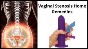 Vaginal Stenosis Home Remedies