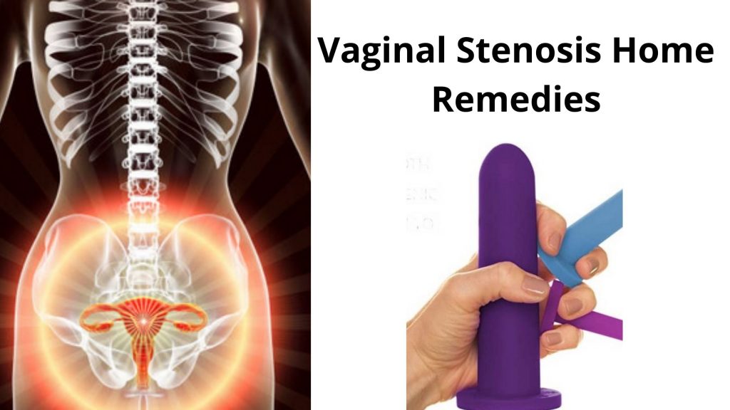 Vaginal Stenosis Home Remedies