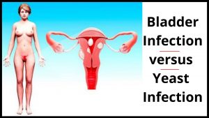 Bladder Infection versus Yeast Infection